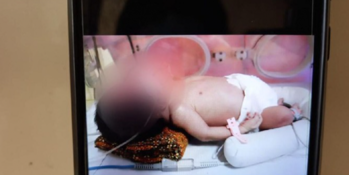 Bayi Kembar Siam Satu Tubuh Berkepala Dua Lahir di Tegal